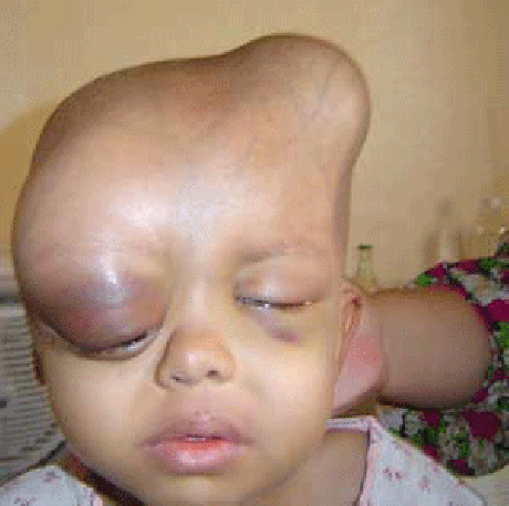 DU deformity