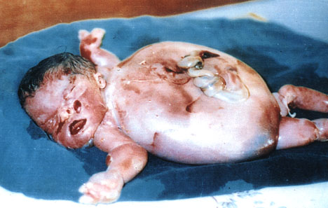 Depleted-uranium-severe-body-deformity_jpg-1
