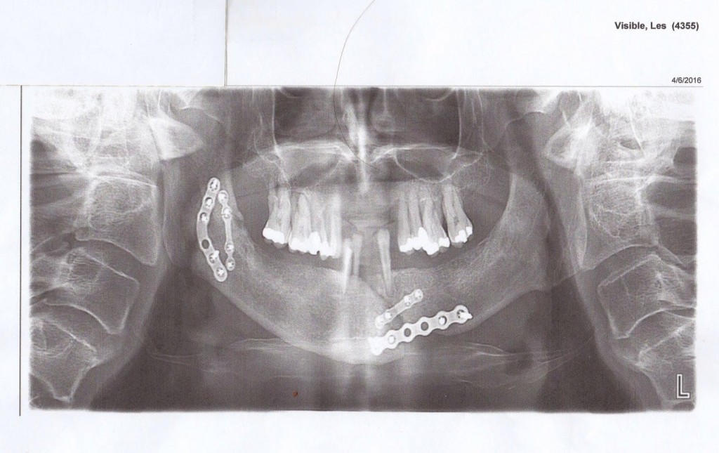 X-ray. Click to enlarge