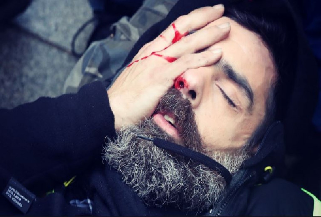 Jerome Rodrigues, Gilets Jaunes spokesperson, targeted with a GLIF4 grenade and a LBD40 bullet which hit him in the eye during Acte XI, Jan 26, 2019. Jerome Rodrigues | Facebook