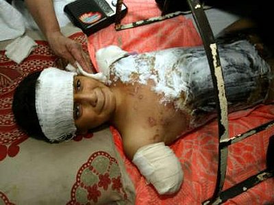 Ali Ismail Abbas, 12, wounded during an airstrike according to hospital sources, lies in a hospital bed in Baghdad, April 6, 2003. Abbas was fast asleep when war shattered his life. A missile obliterated his home and most of his family, leaving him orphaned, badly burned and blowing off both his arms. 'It was midnight when the missile fell on us. My father, my mother and my brother died. My mother was five months pregnant,' the traumatized boy told Reuters at Baghdad's Kindi hospital. 'Our neighbors pulled me out and brought me here. I was unconscious,' he said on Sunday. REUTERS/Faleh Kheiber
